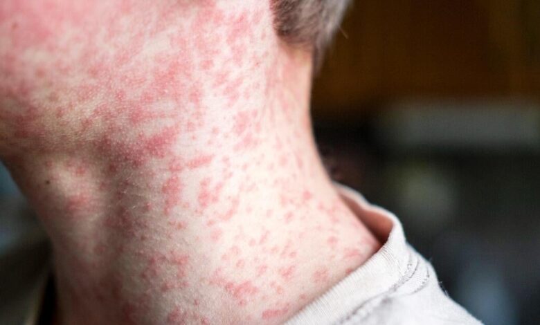Texas child is first reported measles death in U.S. as outbreak spreads Texas child is first reported measles death in U.S. as outbreak spreads
