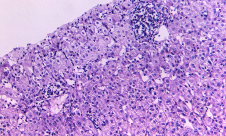 CDC hepatitis lab closes through RIF, imperiling outbreak response