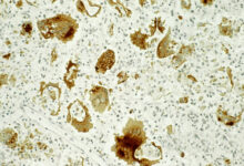 The pain of even ‘mild’ cases of measles, pertussis, and more