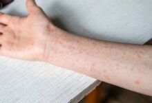 CDC urges summer camps to check for measles immunity, as U.S. nears record