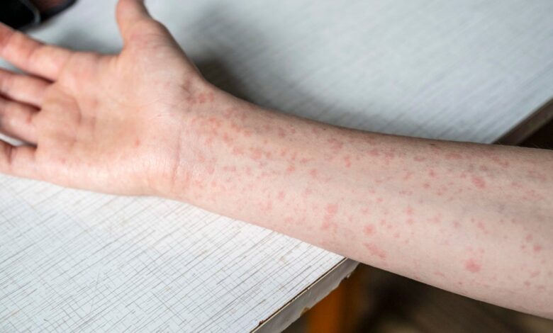 CDC urges summer camps to check for measles immunity, as U.S. nears record CDC urges summer camps to check for measles immunity, as U.S. nears record