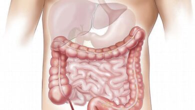 Healthy lifestyle linked to lower diverticulitis risk, irrespective of genetic susceptibility
