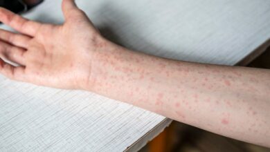 Measles cases in the U.S. hit the highest total recorded in more than 30 years