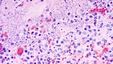 Plague kills Arizona resident, marking first recorded death since 2007, health officials say