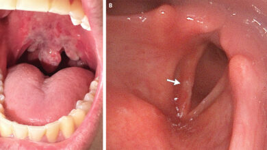 A common sight at concerts, nitrous oxide abuse is soaring, prompting health concerns