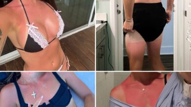 Celebrity Sunburns Guess Who … Lay Off The (Vitamin) D!