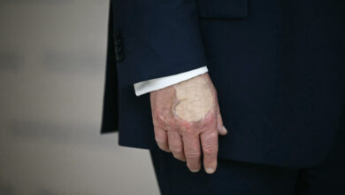 What Trump’s hand bruise signifies, explained by vascular surgeons