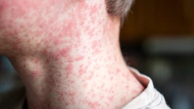 153 unvaccinated students quarantining after measles exposure at South Carolina schools