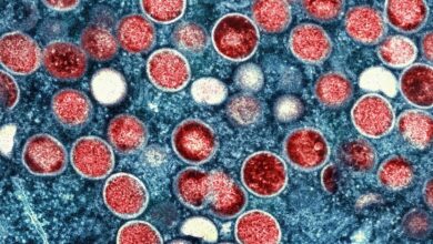 Mpox strain that may be more severe appears to spread locally in U.S. for first time