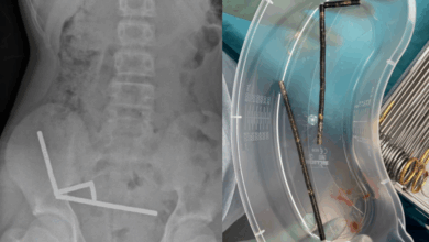 Surgeons remove dozens of magnets from teen’s stomach