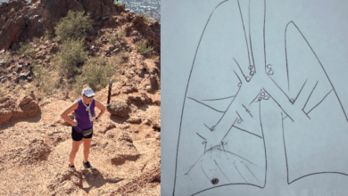 How a broken limb led to a non-smoker’s lung cancer diagnosis a decade later