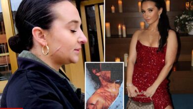 Ex-NJ GOP aide still carries visible scars after she paid fetish artist to carve her up