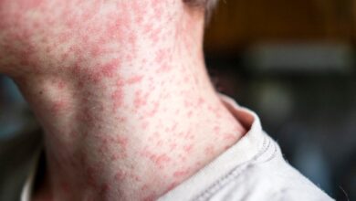 Measles cases surge in South Carolina as U.S. risks losing elimination status