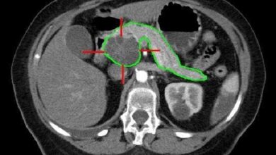 New Cell Therapy Improves Pancreatic Cancer Survival