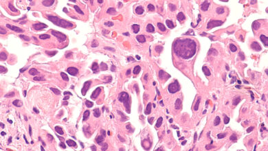 Lung cancer rise among nonsmokers prompts questions on screening