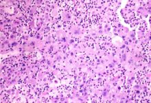 Merck-Kelun lung cancer drug cut tumor progression risk by 65%