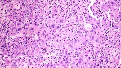 Merck-Kelun lung cancer drug cut tumor progression risk by 65%