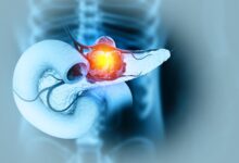 A New Way To Hit Pancreatic Cancer’s Hardest Target