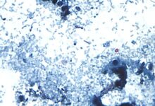 Cyclospora cases have been reported in several states. What to know about the diarrhea-causing parasite.