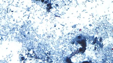 Cyclospora cases have been reported in several states. What to know about the diarrhea-causing parasite. Cyclospora cases have been reported in several states. What to know about the diarrhea-causing parasite.